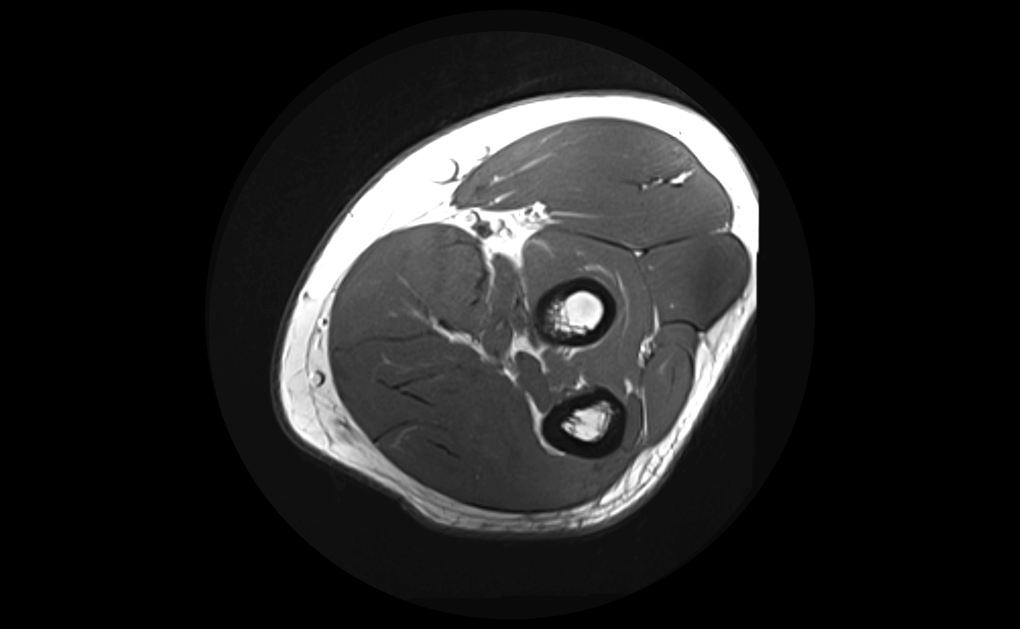 MRI elbow ligaments axial cross sectional anatomy 3T  radiology  image-img-00001-00027.webp